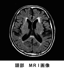 頭部MRI